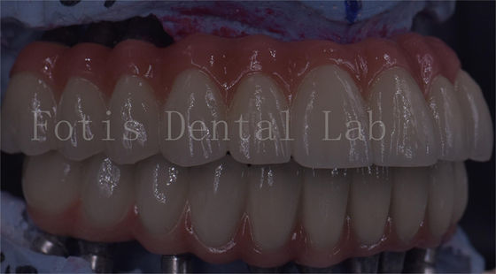 Bom preço. Serviço OEM Implante Dental Durável Coroa Temporária Fácil Manutenção on-line