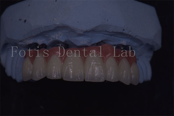 Bom preço. Coroas de implantes dentários de precisão para longevidade e conforto superiores on-line