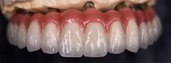Coronas de laboratório dentário resistentes à mancha para várias substituições dentárias
