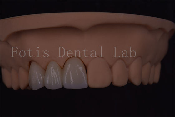Bom preço. Coroas dentárias digitais certificadas ISO para implantes dentários de vários tamanhos on-line