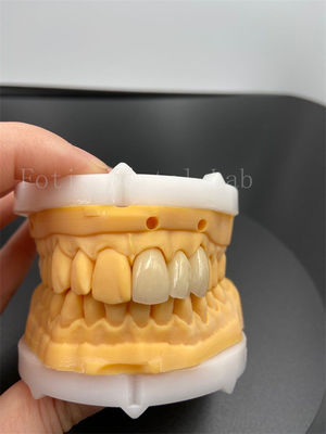 Bom preço. Coronas digitais de ajuste de precisão, implantes dentários com modo de transmissão de e-mail compatível on-line