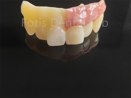 Bom preço. Circônio monolítico revestido de porcelana on-line