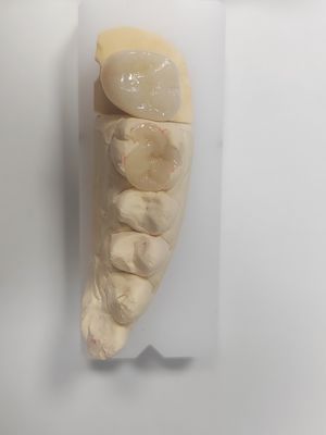 Bom preço. Inlay e Onlay Dentários para Enchimento Indirecto e Restauração da Cor dos Dentes on-line