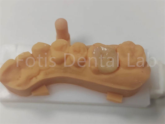 Bom preço. Restaurações Dentárias Incrustação Cerâmica e Incrustação Onlay para duração longa on-line