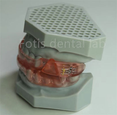 Laboratório Dental Hyrax Expander Retentor Ortodôntico Fácil de Limpar e Manter